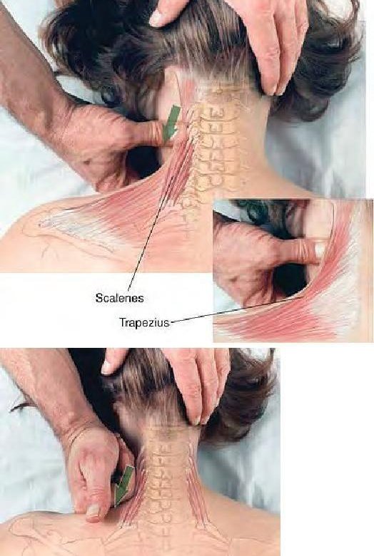 Болит шейно воротниковая зона после массажа. Триггерная точка воротниковой зоны. Триггерные точки шейного отдела. Триггерные точки мышц шеи. Триггерные точки трапециевидной мышцы.